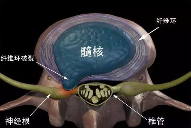 腰椎間盤突出怎么辦?膏藥有木有效果?