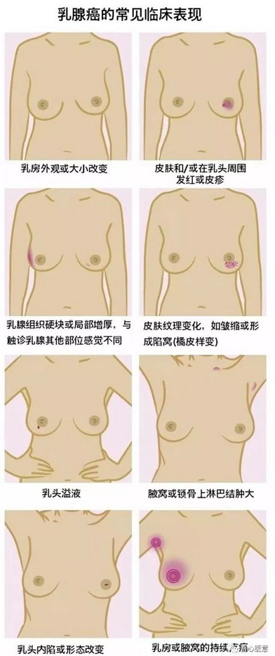 乳腺癌發(fā)生轉(zhuǎn)移了，手術(shù)還有意義嗎？